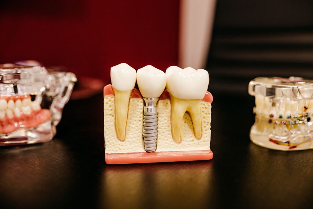 Close-up of a dental implant model showing artificial tooth structure between natural teeth