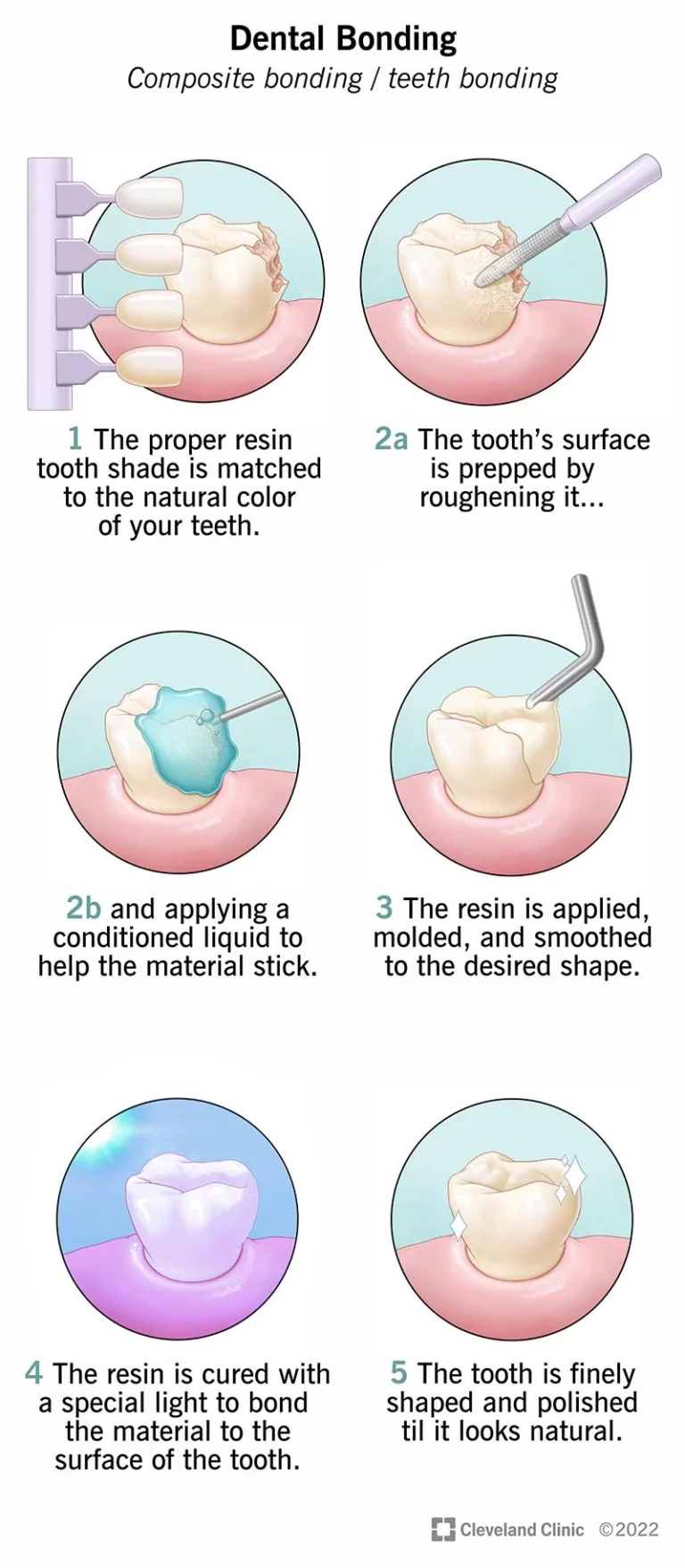 Illustration of composite bonding process, detailing how resin is applied and cured to a tooth.