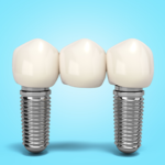 Illustration of a three-unit dental bridge supported by two dental implants.