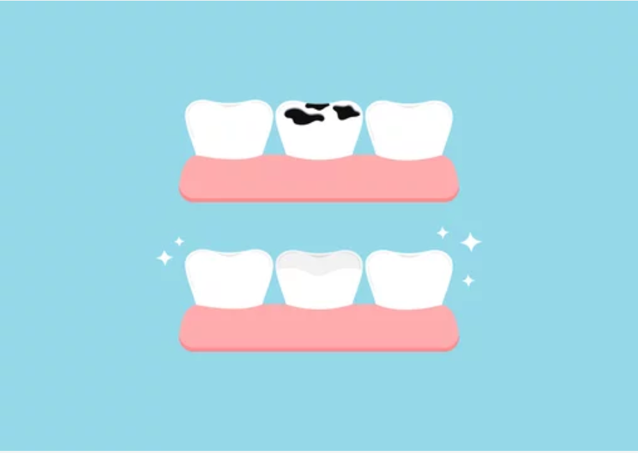 A "before and after" illustration showing a tooth with a black cavity on the top row, and the same tooth restored with a white filling on the bottom row, on a blue background.