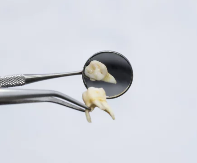 A close-up of a dental mirror reflecting an extracted tooth, while another extracted tooth is held by a pair of tweezers in the foreground, against a white background.