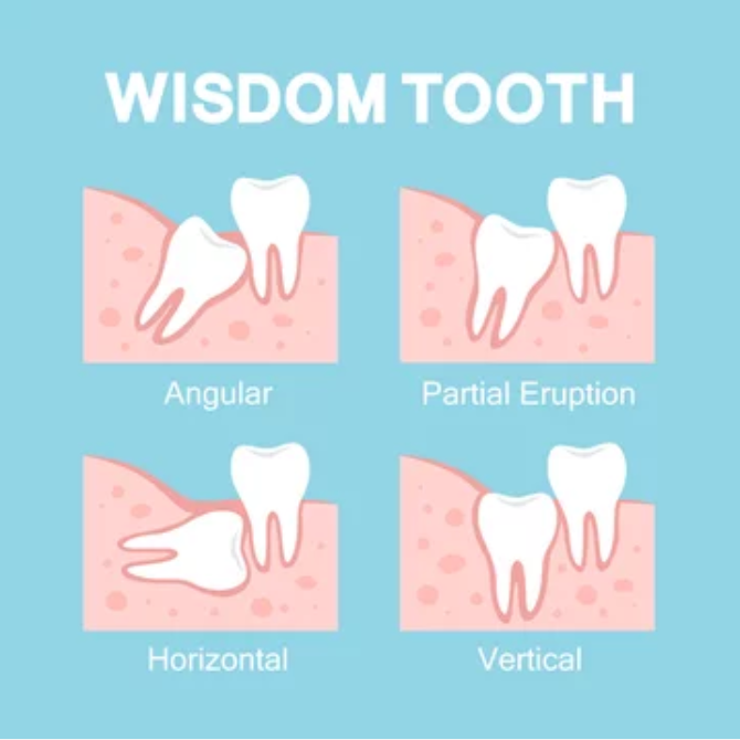 Visual guide to wisdom tooth types, demonstrating common impaction scenarios.
