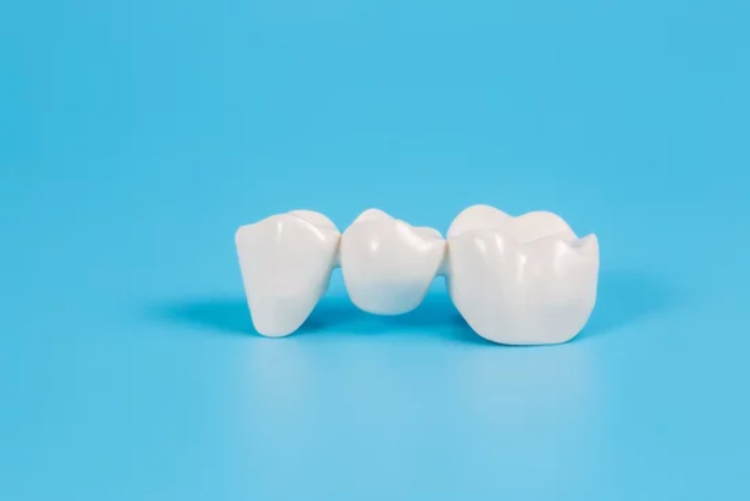 A three-unit dental bridge, composed of three connected white crowns,