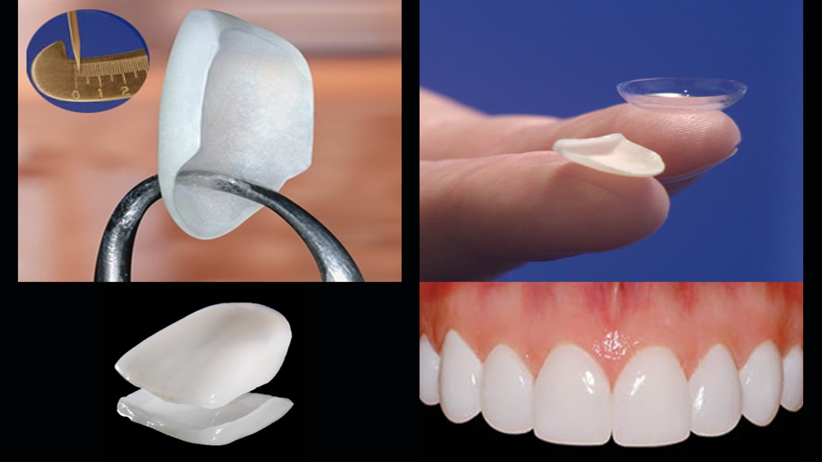 A collage demonstrating the process and result of porcelain veneers, including measurement, a thin veneer on a finger, a separated veneer, and a perfect smile.