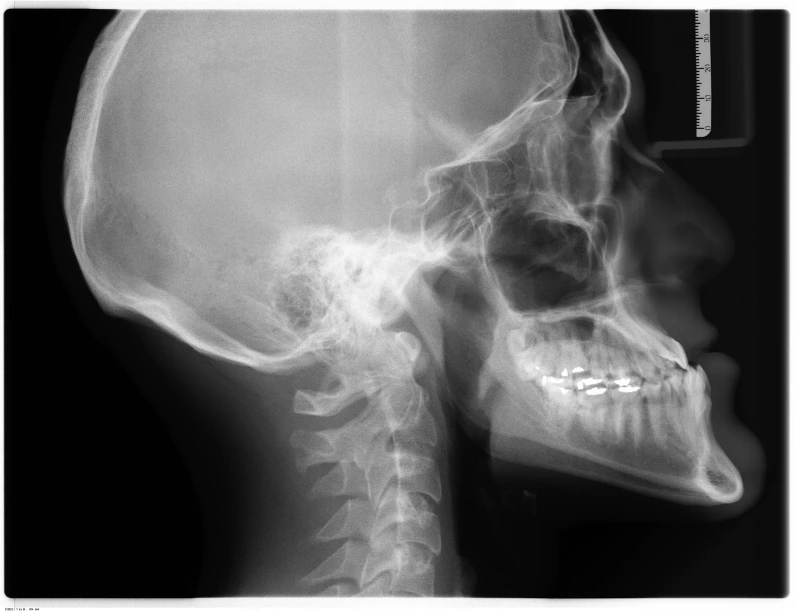 Implant Failure Risk Factors and Prevention Strategies